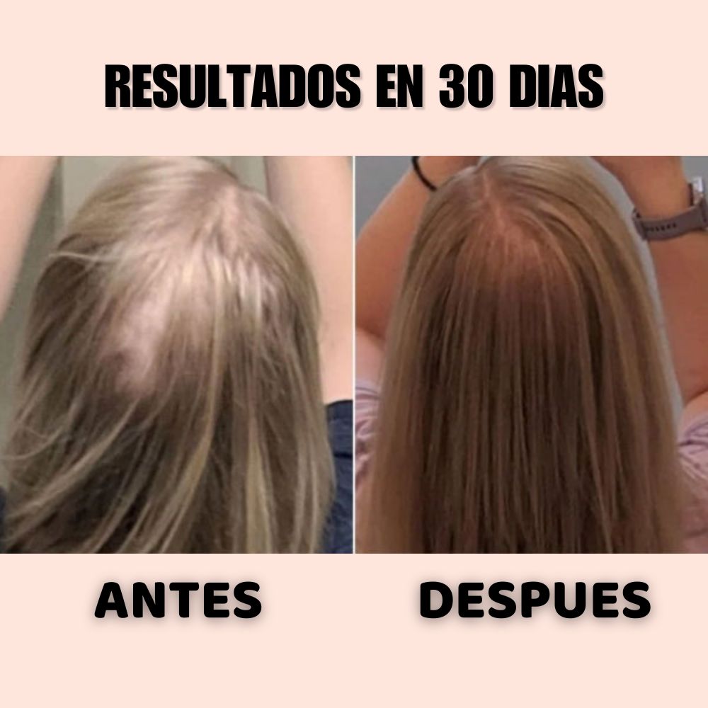 TONICO ANTERA 👉 RECUPERA TU CABELLO EN 30 DIAS O TE DEVOLVEMOS TU DINERO