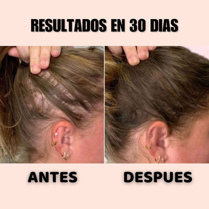 TONICO ANTERA 👉 RECUPERA TU CABELLO EN 30 DIAS O TE DEVOLVEMOS TU DINERO